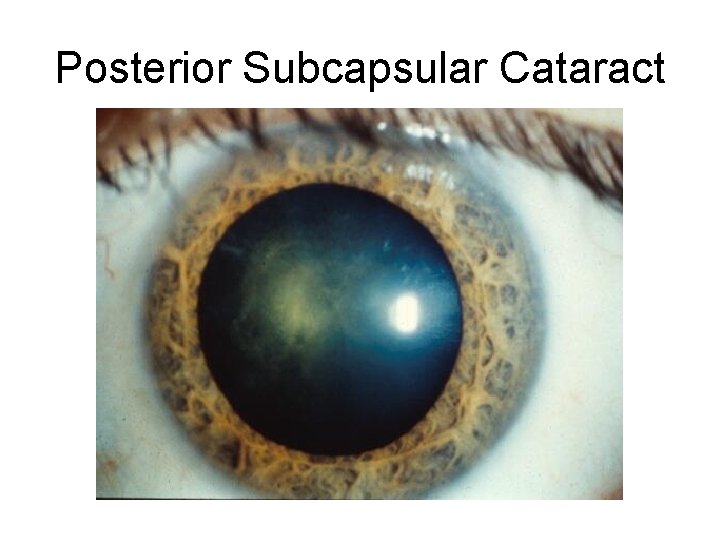 Posterior Subcapsular Cataract 