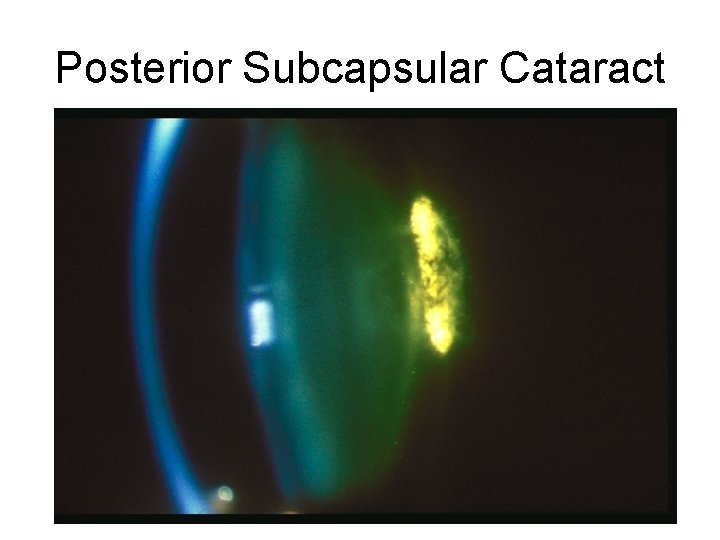 Posterior Subcapsular Cataract 