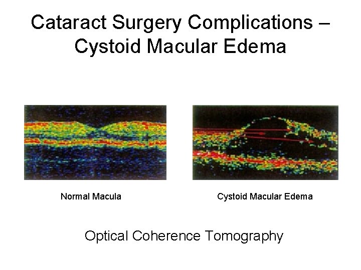 Cataract Surgery Complications – Cystoid Macular Edema Normal Macula Cystoid Macular Edema Optical Coherence