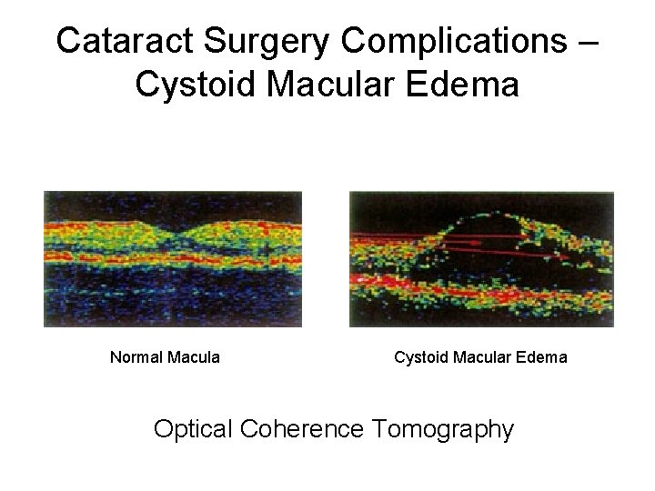 Cataract Surgery Complications – Cystoid Macular Edema Normal Macula Cystoid Macular Edema Optical Coherence Cataract Surgery Complications – Cystoid Macular Edema Normal Macula Cystoid Macular Edema Optical Coherence