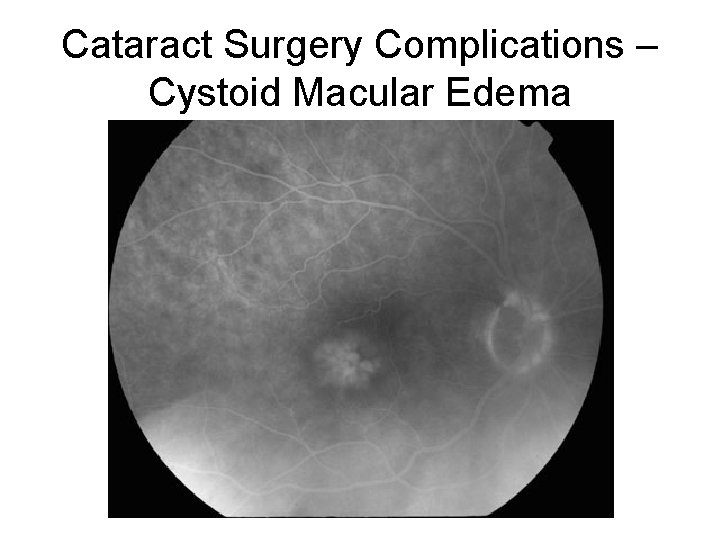 Cataract Surgery Complications – Cystoid Macular Edema 