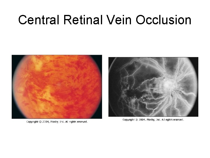 Central Retinal Vein Occlusion Central Retinal Vein Occlusion