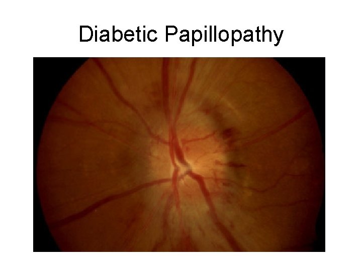 Diabetic Papillopathy Diabetic Papillopathy