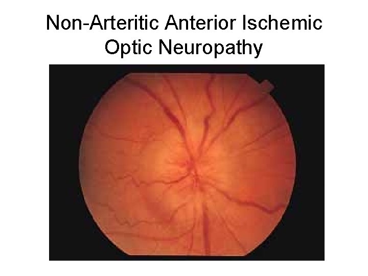 Non-Arteritic Anterior Ischemic Optic Neuropathy Non-Arteritic Anterior Ischemic Optic Neuropathy