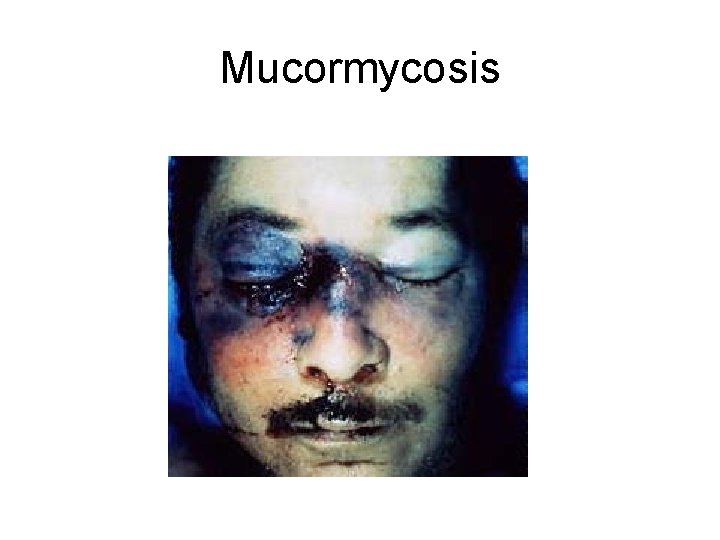 Mucormycosis 