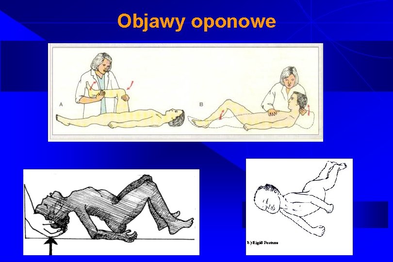 Objawy oponowe 