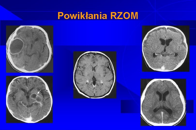 Powikłania RZOM 