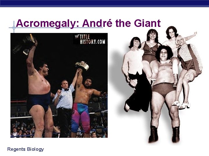Acromegaly: André the Giant Regents Biology 