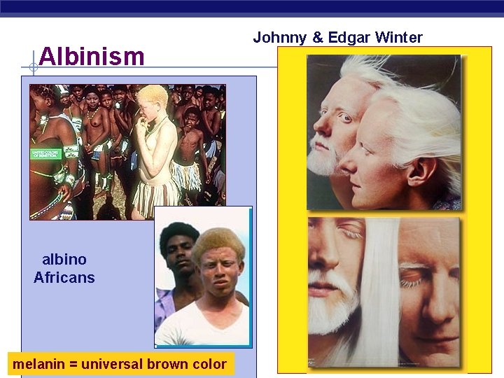 Albinism albino Africans Regents Biology melanin = universal brown color Johnny & Edgar Winter