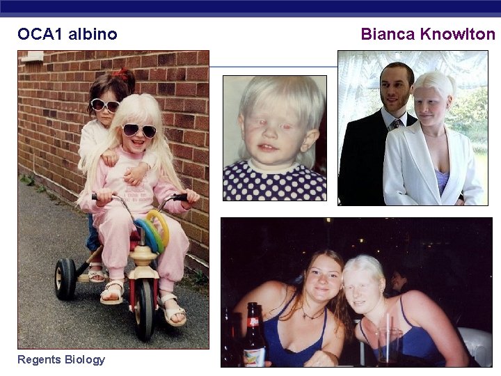 OCA 1 albino Regents Biology Bianca Knowlton 