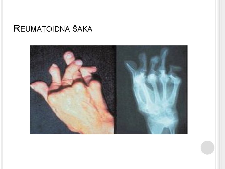 REUMATOIDNA ŠAKA 