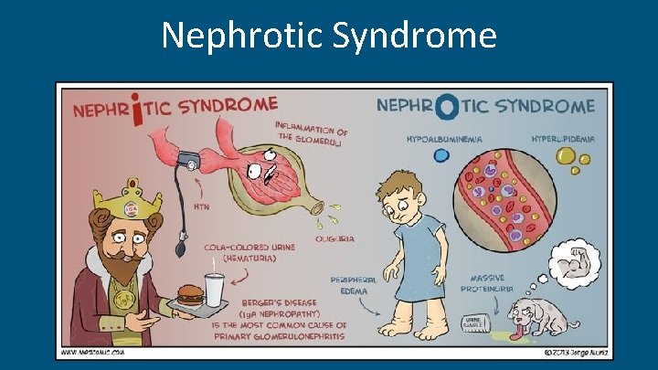 Nephrotic Syndrome 