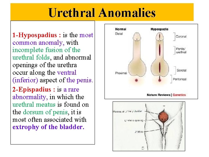 Urethral Anomalies 1 -Hypospadius : is the most common anomaly, with incomplete fusion of