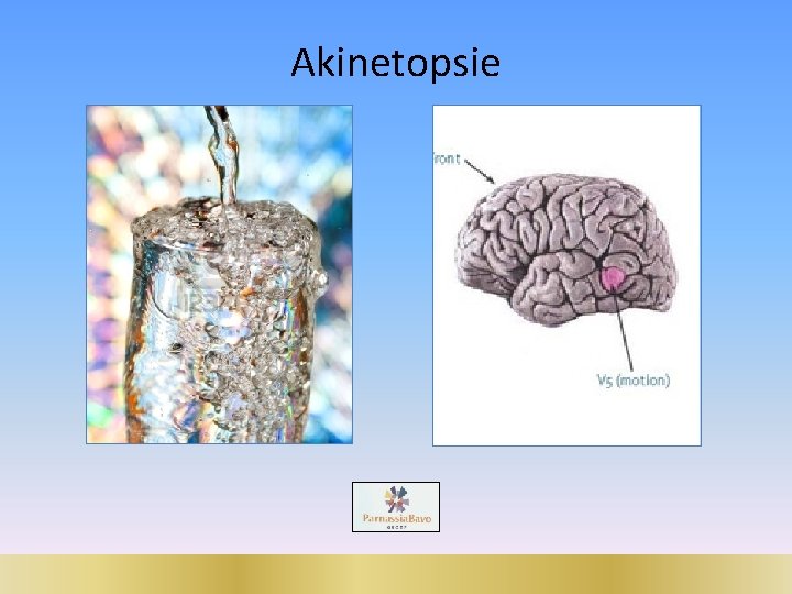 Akinetopsie 