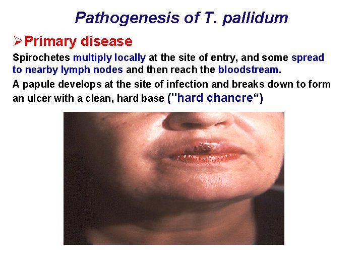 Pathogenesis of T. pallidum ØPrimary disease Spirochetes multiply locally at the site of entry,