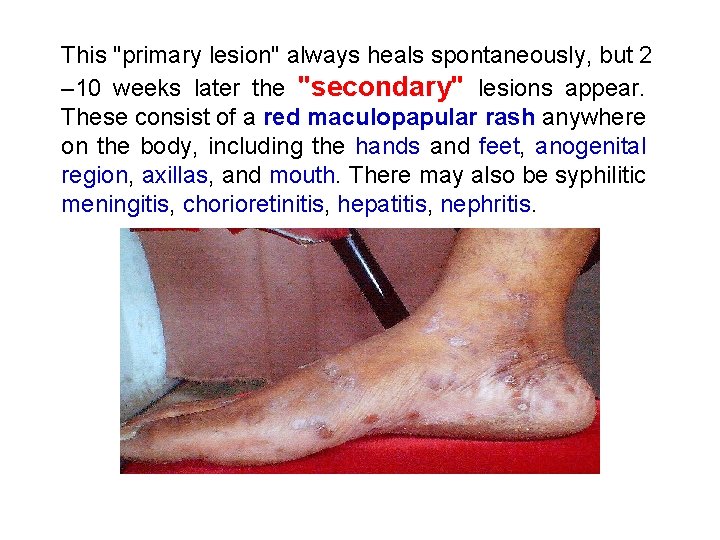 This "primary lesion" always heals spontaneously, but 2 – 10 weeks later the "secondary"