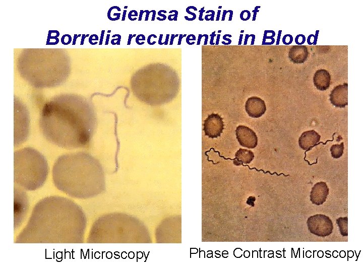 Giemsa Stain of Borrelia recurrentis in Blood Light Microscopy Phase Contrast Microscopy 