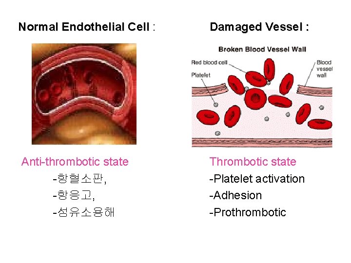 Normal Endothelial Cell : Damaged Vessel : Anti-thrombotic state -항혈소판, -항응고, -섬유소용해 Thrombotic state