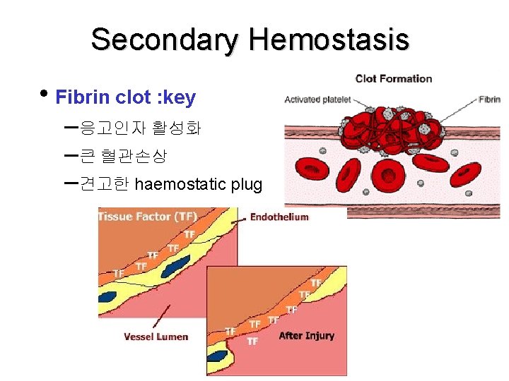 Secondary Hemostasis • Fibrin clot : key –응고인자 활성화 –큰 혈관손상 –견고한 haemostatic plug