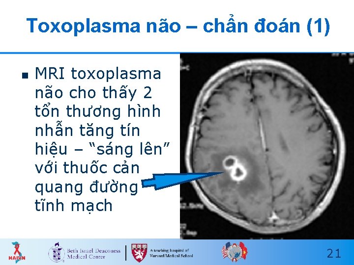 Toxoplasma não – chẩn đoán (1) n MRI toxoplasma não cho thấy 2 tổn