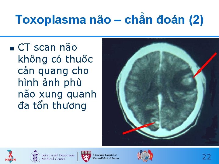 Toxoplasma não – chẩn đoán (2) n CT scan não không có thuốc cản