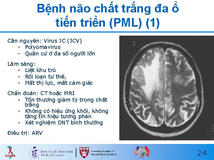 Bệnh não chất trắng đa ổ tiến triển (PML) (1) Căn nguyên: Virus JC