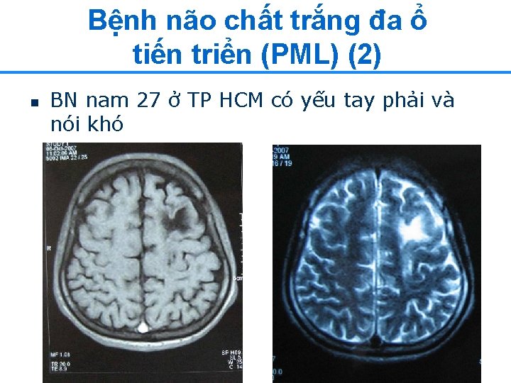 Bệnh não chất trắng đa ổ tiến triển (PML) (2) n BN nam 27