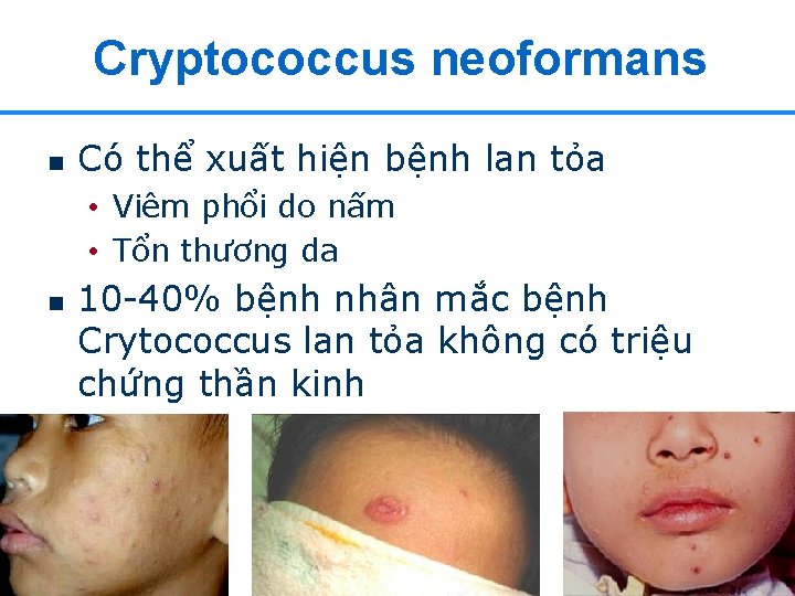 Cryptococcus neoformans n Có thể xuất hiện bệnh lan tỏa • Viêm phổi do