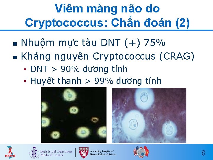 Viêm màng não do Cryptococcus: Chẩn đoán (2) n n Nhuộm mực tàu DNT