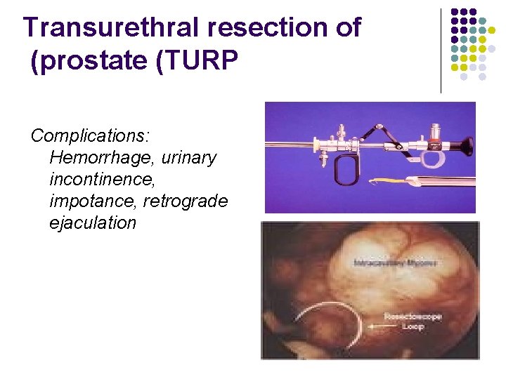 Transurethral resection of (prostate (TURP Complications: Hemorrhage, urinary incontinence, impotance, retrograde ejaculation 