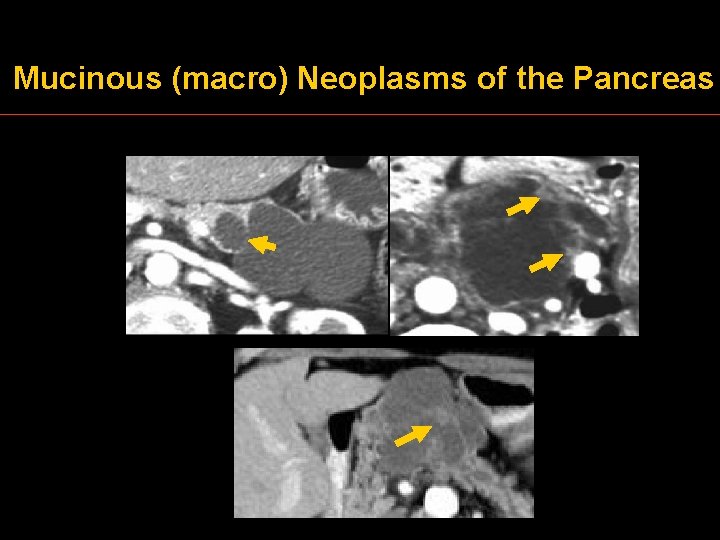 Mucinous (macro) Neoplasms of the Pancreas 