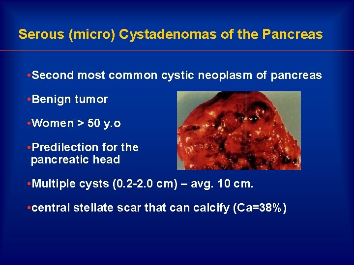 Serous (micro) Cystadenomas of the Pancreas • Second most common cystic neoplasm of pancreas
