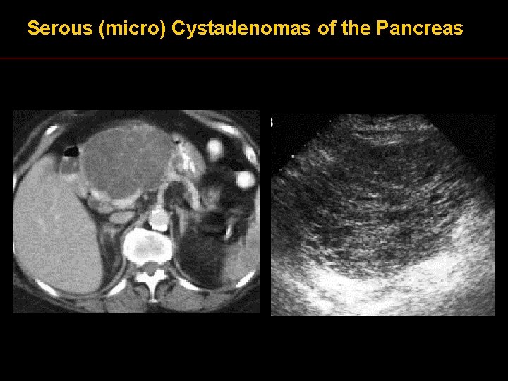 Serous (micro) Cystadenomas of the Pancreas 