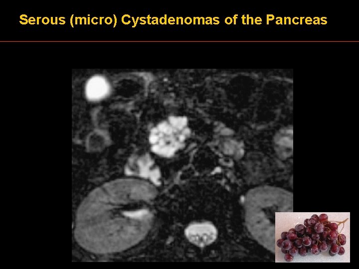 Serous (micro) Cystadenomas of the Pancreas 