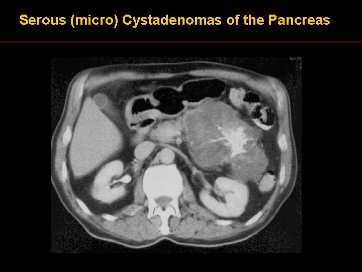 Serous (micro) Cystadenomas of the Pancreas 