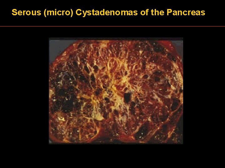 Serous (micro) Cystadenomas of the Pancreas 