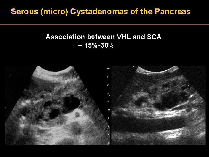 Serous (micro) Cystadenomas of the Pancreas Association between VHL and SCA – 15%-30% 