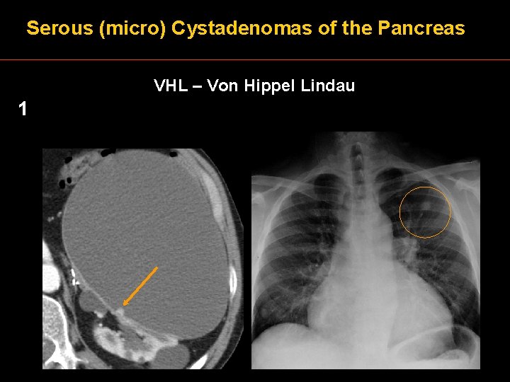 Serous (micro) Cystadenomas of the Pancreas VHL – Von Hippel Lindau 1 