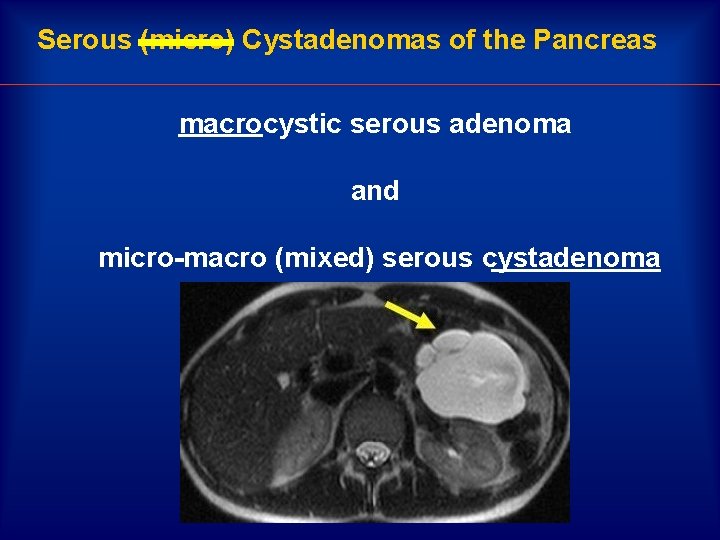 Serous (micro) Cystadenomas of the Pancreas macrocystic serous adenoma and micro-macro (mixed) serous cystadenoma
