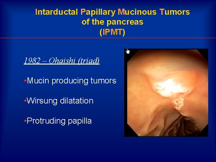 Intarductal Papillary Mucinous Tumors of the pancreas (IPMT) 1982 – Ohaishi (triad) • Mucin