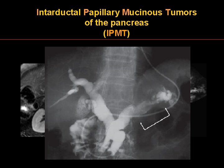 Intarductal Papillary Mucinous Tumors of the pancreas (IPMT) 