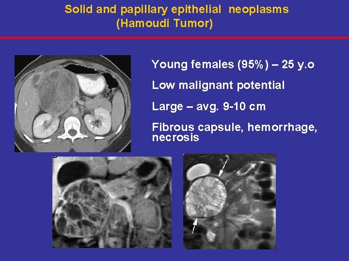 Solid and papillary epithelial neoplasms (Hamoudi Tumor) Young females (95%) – 25 y. o