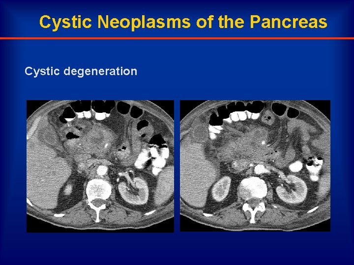 Cystic Neoplasms of the Pancreas Cystic degeneration 