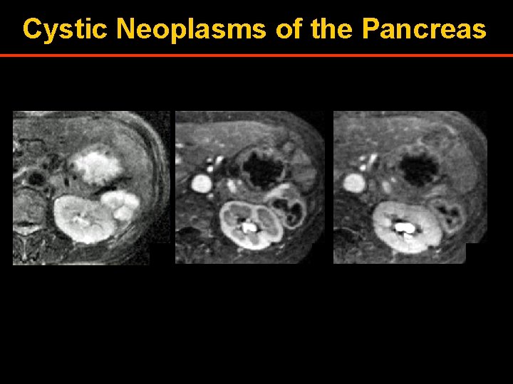 Cystic Neoplasms of the Pancreas 