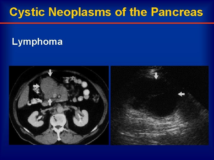 Cystic Neoplasms of the Pancreas Lymphoma 