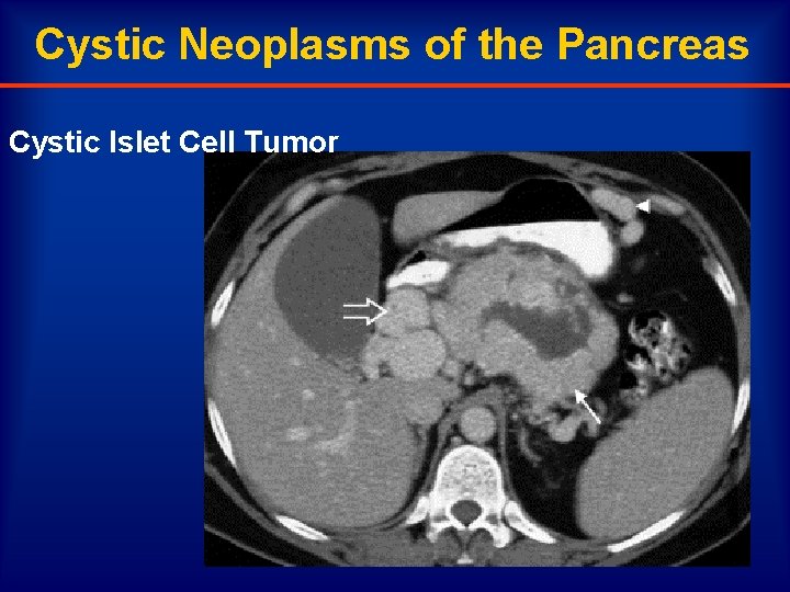 Cystic Neoplasms of the Pancreas Cystic Islet Cell Tumor 
