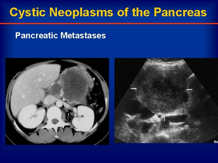 Cystic Neoplasms of the Pancreas Pancreatic Metastases 