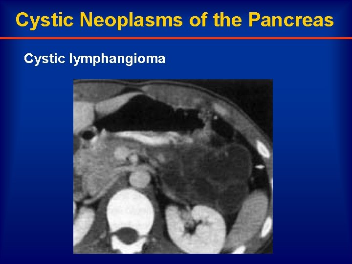 Cystic Neoplasms of the Pancreas Cystic lymphangioma 