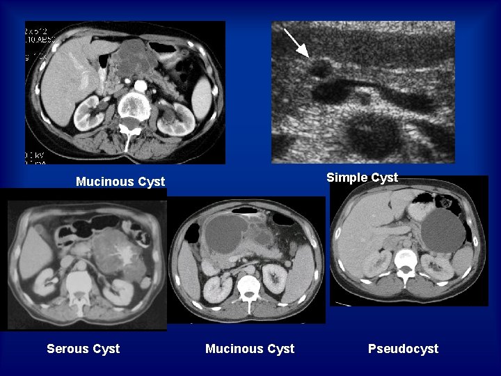 Simple Cyst Mucinous Cyst Serous Cyst Mucinous Cyst Pseudocyst 