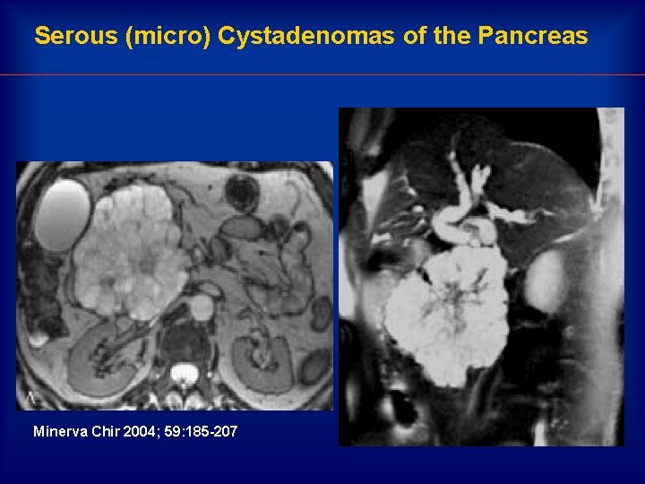 Serous (micro) Cystadenomas of the Pancreas Minerva Chir 2004; 59: 185 -207 